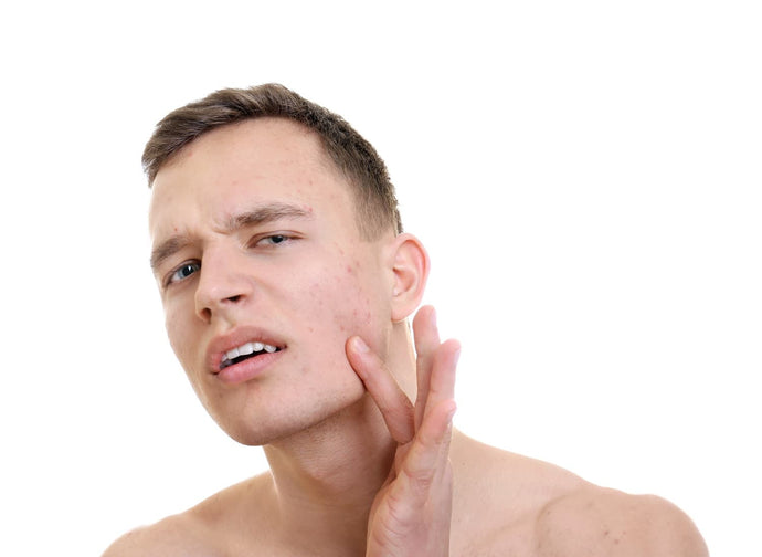 Cómo mejorar tu piel si tienes acné, eccema, psoriasis, rosácea, vitíligo o dermatitis seborreica