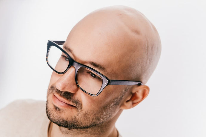 ¿La piel tensa de tu cabeza te está dejando calvo? Averigua por qué